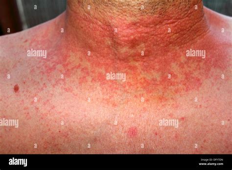 Dermititis Should Be Dermatitisred Skin Rash On A Man´s Neck And Chest