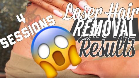 Bikini Laser Hair Removal Visual Results After Four Sessions Youtube