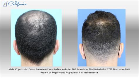 Hair Growth Time Lapse Case Study Case Study Sara Wasserbauer Md