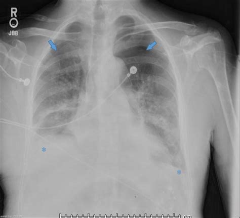 After months of having a feeding tube, is it finally time for cassidy to have her ng feeding tube out?subscribe & hit that notification bell to join our. Chest x-ray after feeding tube was removed, revealing ...