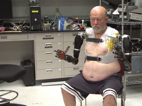 A Man Who Lost Both Arms Years Ago Is Making History As The First Person With Two Mind