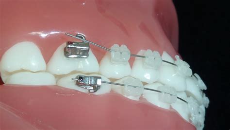 Orthodontic Emergencies Solihull Adult Braces Sutton Coldfield