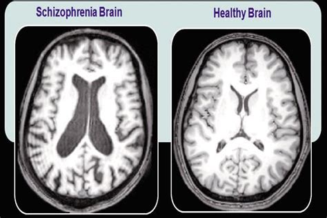 An Overview Of Schizophrenia And Similar Psychotic Disorders