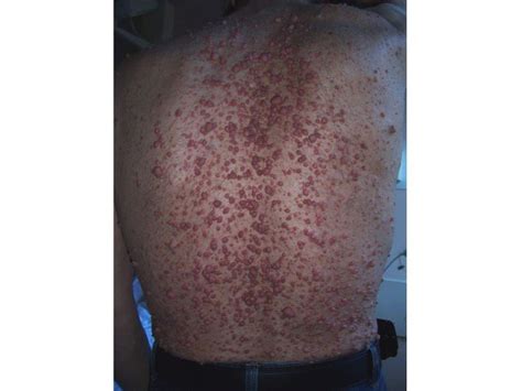 Multimodal imaging in neurofibromatosis type. Neurofibromatosis Type 1