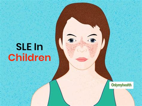 Systemic Lupus Erythematosus In Kids Understanding Sle And Its