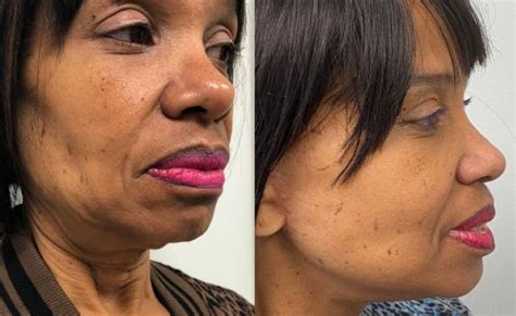 How To Lift A Saggy Neck Bala Cynwyd Neck Lift Dr Anthony Farole