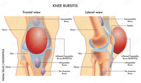 Knee Bursas Bursitis Knee Bursitis Prepatellar Bursitis Hot Sex Picture