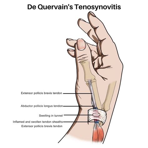 De Quervain S Tenosynovitis Orchard Health Clinic Osteopathy