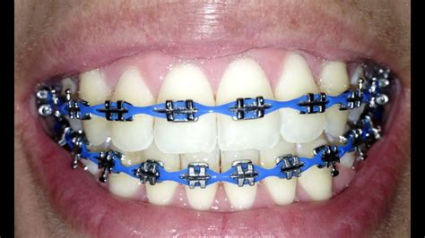 Braces Update 26 Power Chains Youtube
