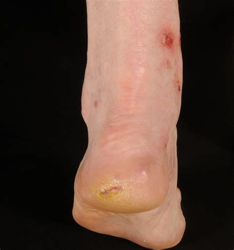 Non Healing Leg Ulcer The Bmj