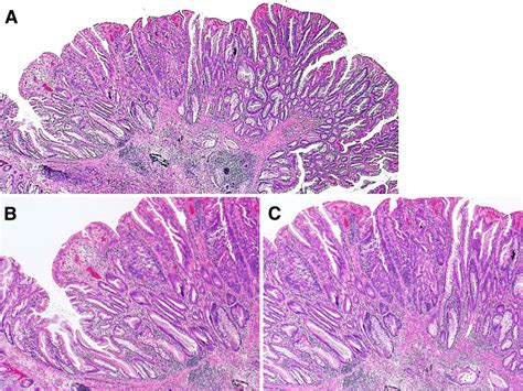 Molecular Characterization Of Sessile Serrated Adenoma Polyps With