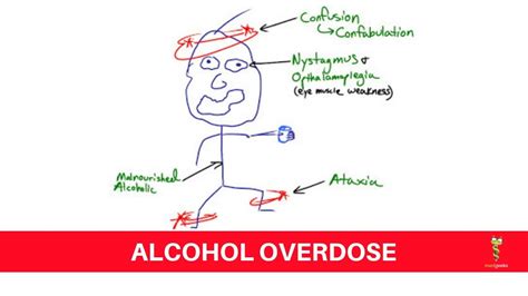 Acute Alcohol Intoxication Youtube
