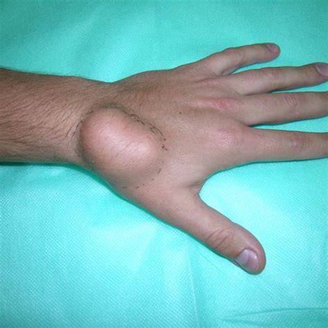 Retrieval Of Lipoma Located Deep In The Hand Download Scientific Diagram