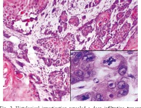 A Rapidly Growing Squamous Cell Carcinoma Or Keratoacanthoma Or Both