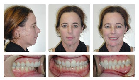 Orthodontic Before And After Photos Brodsky Orthodontics