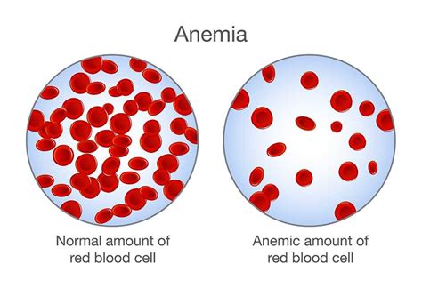Anemia 13 Warning Signs And Symptoms Of Anemia Left Side Pains