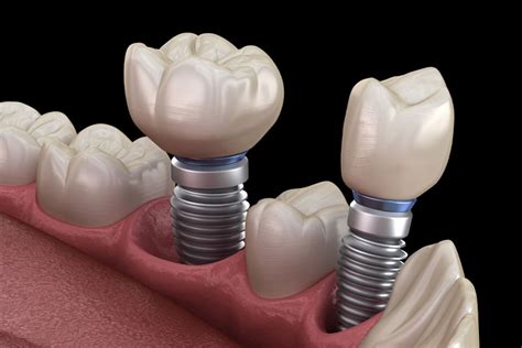 Dental Implants Osseointegration And Titanium Posts
