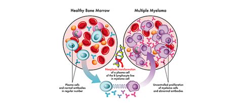 Effective Multiple Myeloma Treatment Strategies Causes And Symptoms