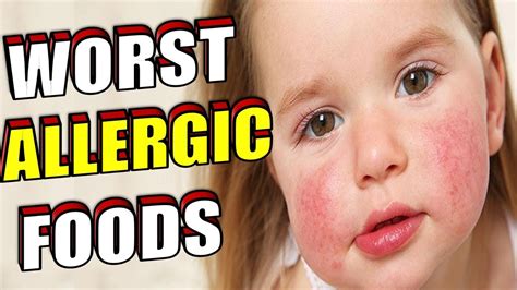 The 8 Worst Foods That Cause The Most Allergic Reactions Youtube