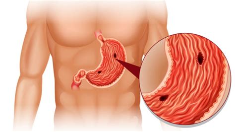 Gastritis merupakan radang yang terjadi di lambung. Gastritis Merupakan Panyakit Karena Gangguan ? : Gastritis kronis korpus ( gastritis tipe a ...