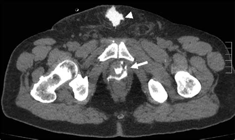 A Ct Scan Showing Leakage Of Contrast At The Level Of The Download
