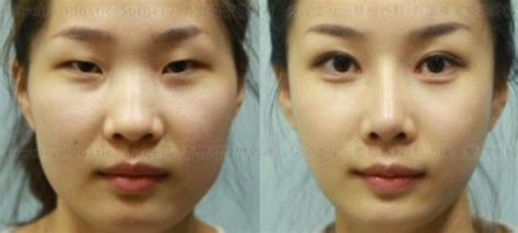 South Korean Plastic Surgery So Good People Need Certificates To Prove