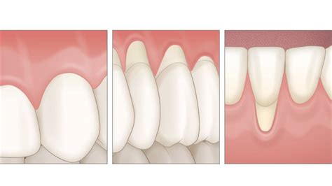 Gingival Recession Causes Diagnosis Therapy And Prevention