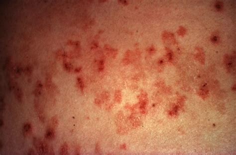 Dermatitis Herpetiformis Pictures Symptoms Causes Treatment