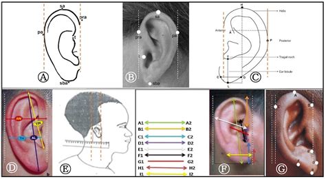 The Human Ear The Auricle Part 2 Hearing Health And Technology Matters