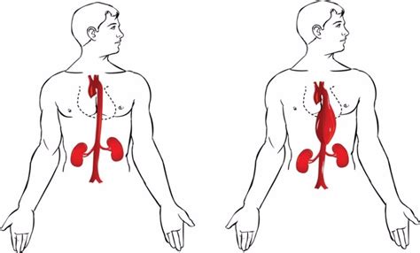 Although your aorta is a tough, durable workhorse, sometimes its walls can weaken and bulge in what is called an aortic aneurysm. Aneurisma de aorta: accidente en la autopista central