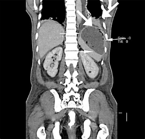 Ct Scan Of The Abdomen Showing Splenic Abscess Thin Wh Open I