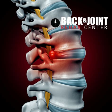 Herniated Disc Disc Herniation Chiropractor Lower Back Pain Therapy