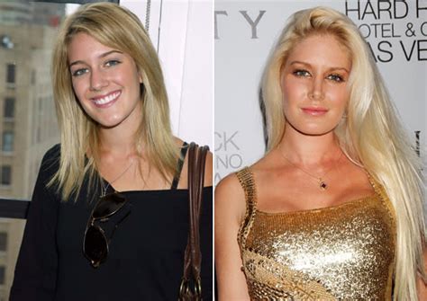 Heidi Montags Surgery Before And After Through The Years