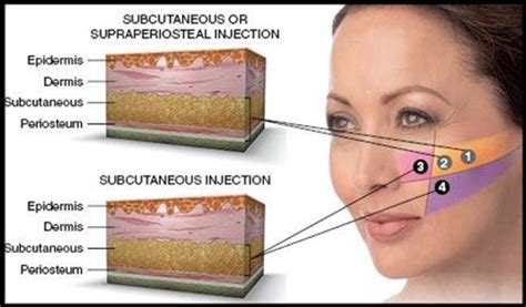 A subcutaneous injection is administered as a bolus into the subcutis, the layer of skin directly below the dermis and epidermis, collectively referred to as the cutis. Facial Filler Injections - MSPRS