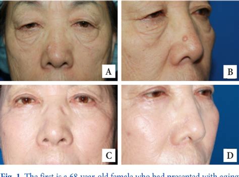Figure 1 From Malignant Skin Tumor Misdiagnosed As A Benign Skin Lesion