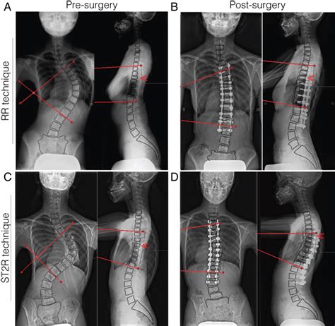 A A Female Ais Patient Presented With Abnormal Curvature Of The Spine