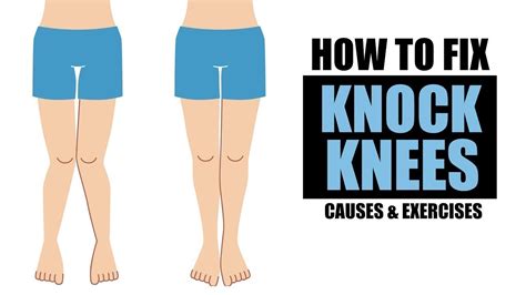 Knock Knee How To Fix Knock Knee How To Solve Knock Knee By Exercise Knock Knees Problems Youtube
