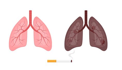 Paruparu Sehat Dan Paruparu Perokok Konsep Kanker Rokok Penyakit
