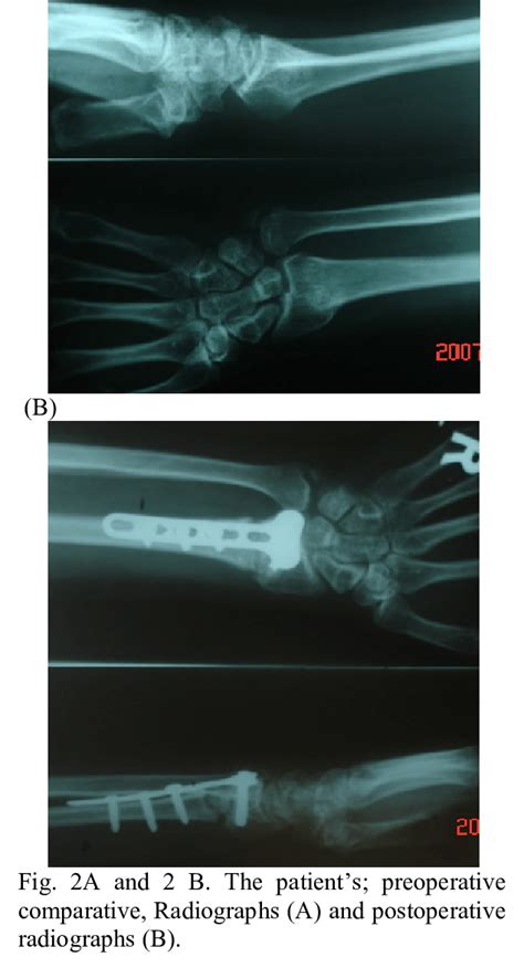 Dorsal Approach Was Used For Osteotomy And Fixation In Patients With