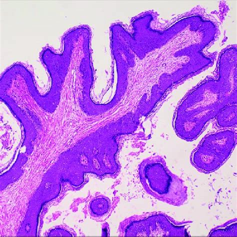 Pdf Umbilical Squamous Papilloma A Case Report