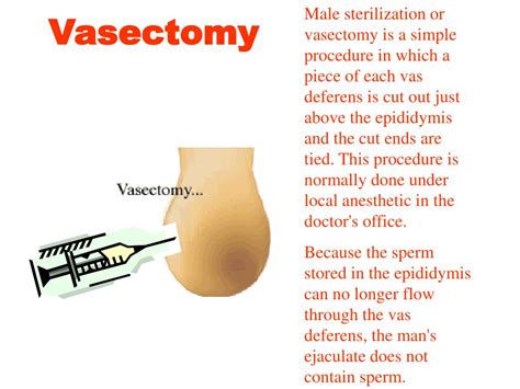 Vasectomy Procedure