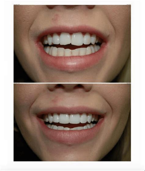 Composite Veneers We Compare Safety Durability Aesthetic And Price