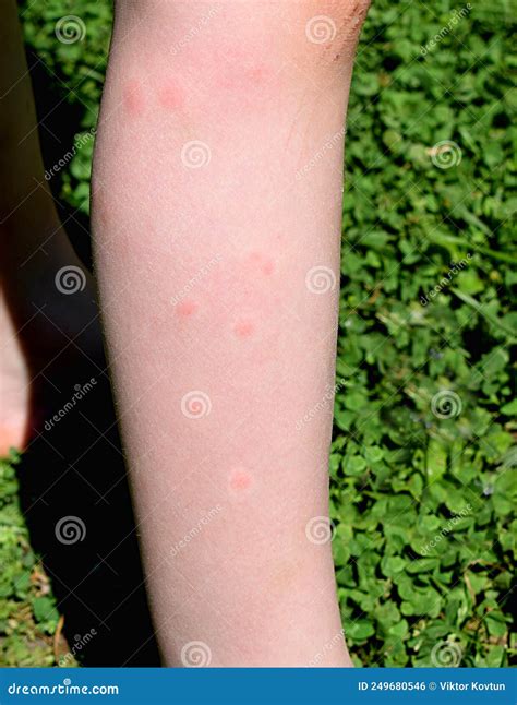 Blisters On A Girl S Leg Caused By Mosquito Bites Stock Photo Image