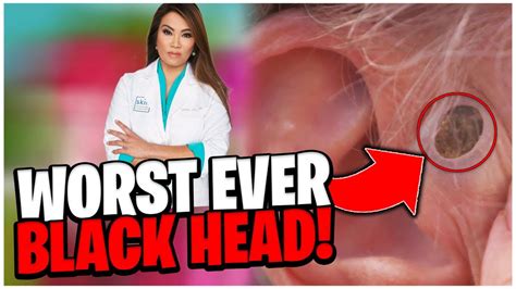 Dr Pimple Poppers 5 Worst Blackhead Extractions 🤢 Super Gross
