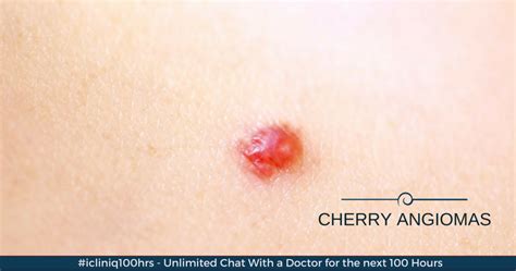 How Can Cherry Angiomas Be Treated