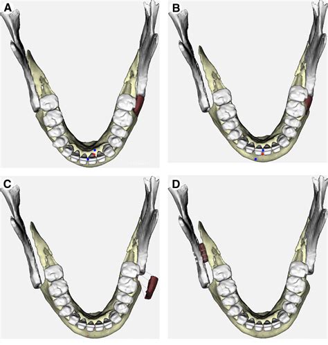 Modification Of The Bilateral Sagittal Split Osteotomy For The