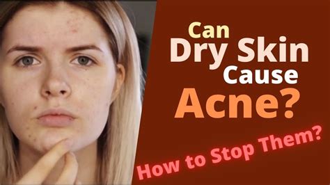 Can Dry Skin Cause Acne Why Does It Cause Acne Youtube