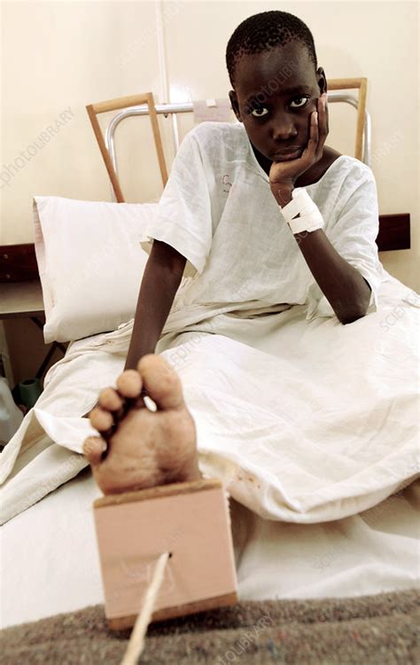 Boy In A Hospital Bed Stock Image M9350404 Science Photo Library