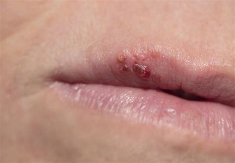 Herpes On Lips Causes Cheap Store Save 61 Jlcatj Gob Mx