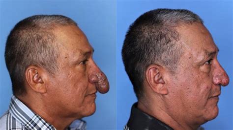 New York Painter With Rare Deformity Gets New Nose For Christmas